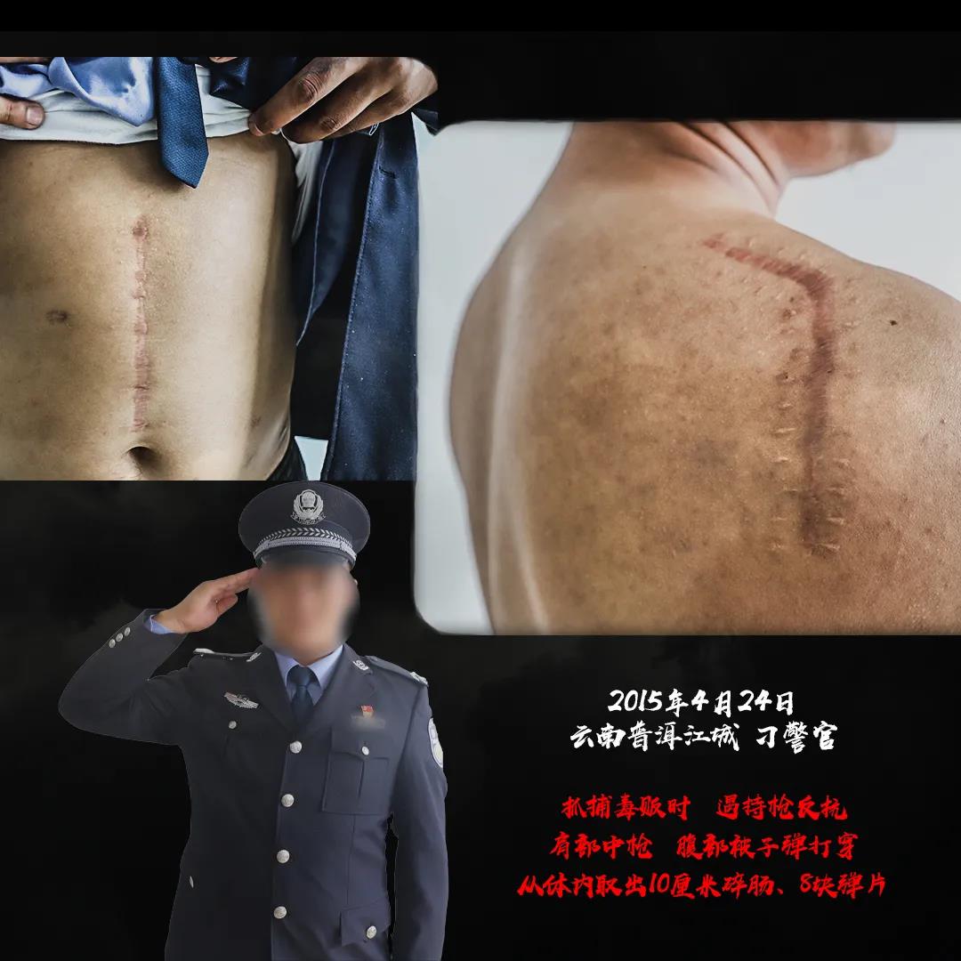 摔伤、刀片割伤要留意 松山医院：部分伤口需注射破伤风进行预防